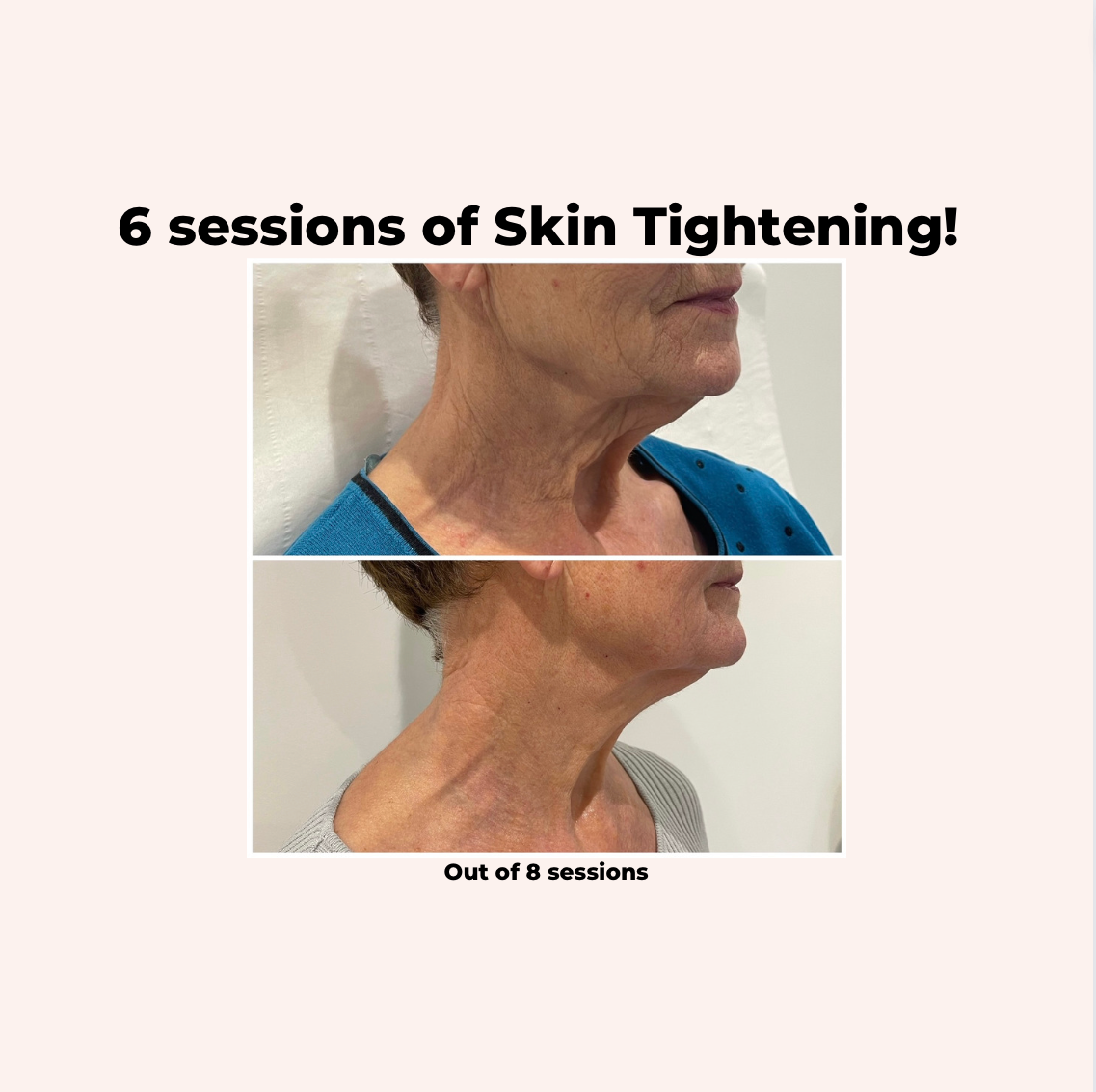 Radio Frequency Face and Neck - Package