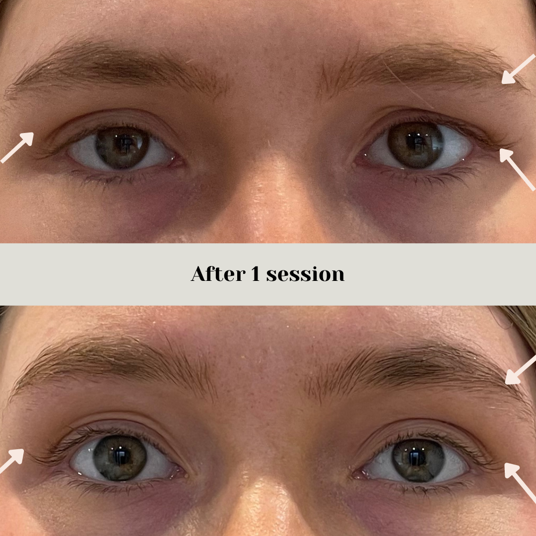 Non-Surgical Brow Lift