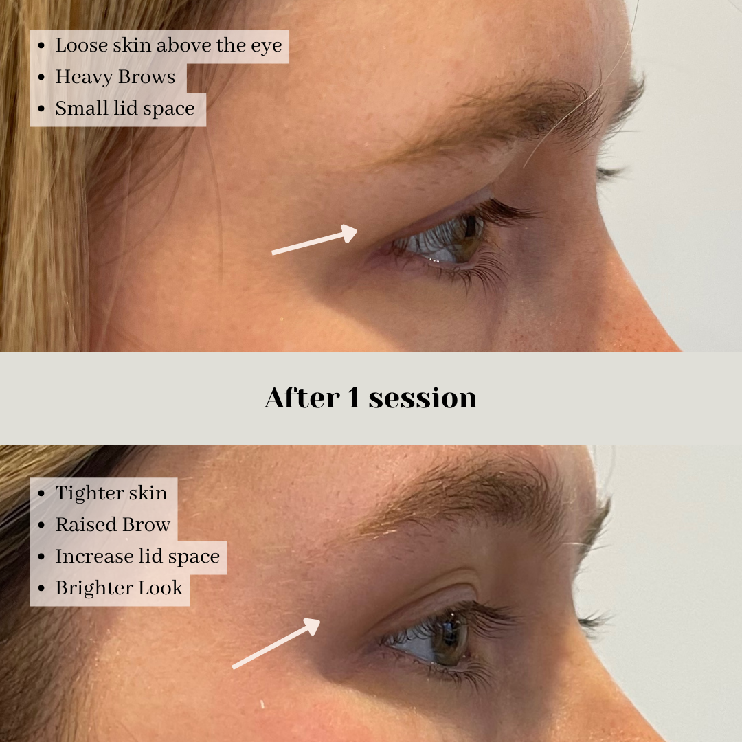 Non-Surgical Brow Lift
