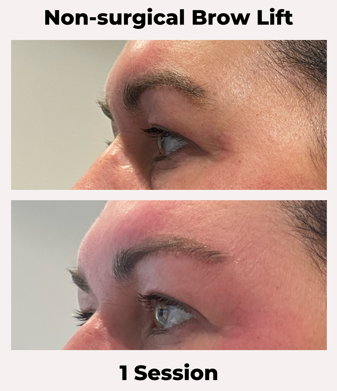 Non-Surgical Brow Lift