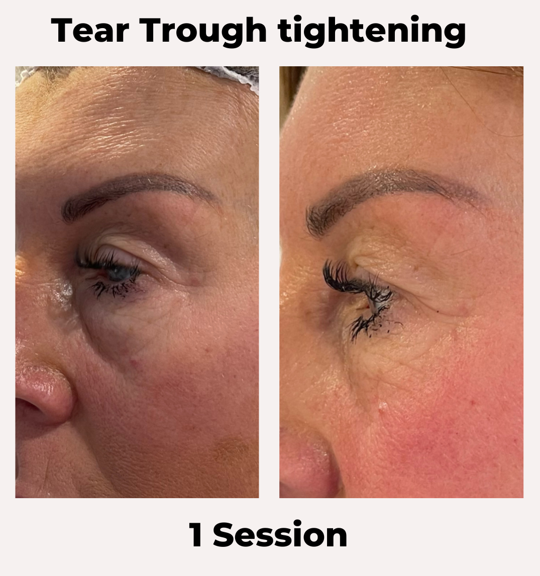Non-Surgical Brow Lift