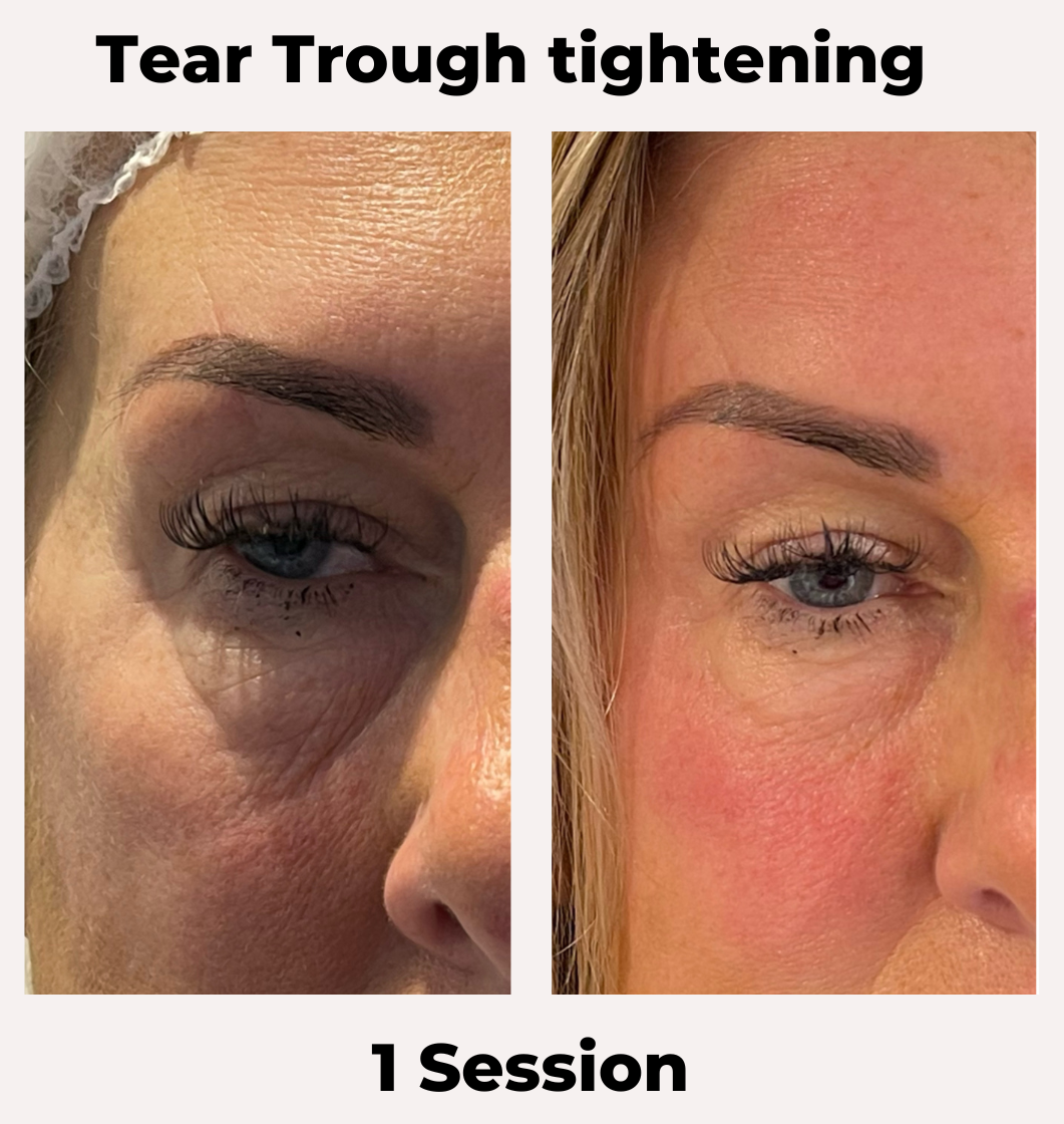 Non-Surgical Brow Lift