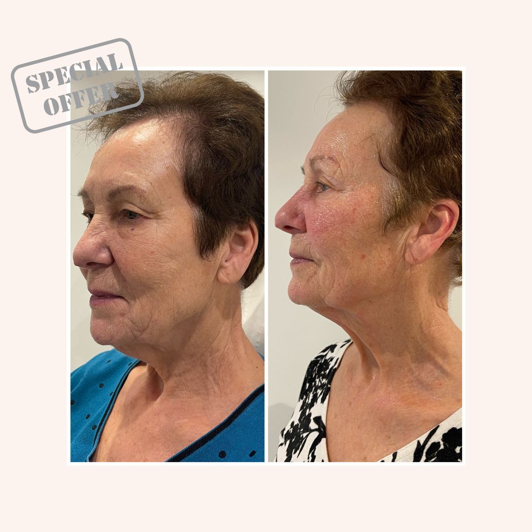 Radio Frequency Face and Neck - Package