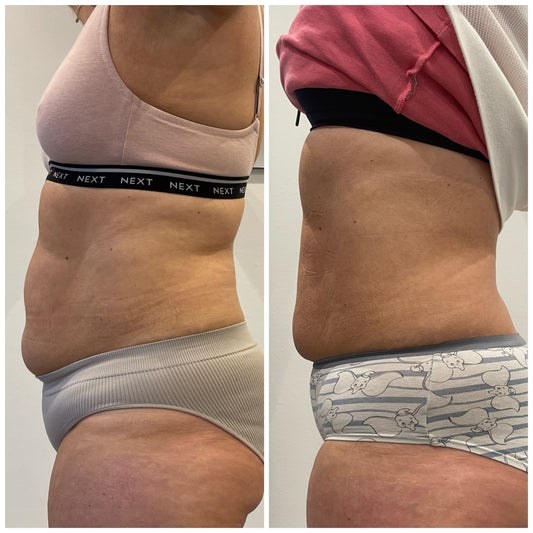 3D Lipo vs. Other Fat Reduction Treatments: We put them head-to-head to see which comes out on top.