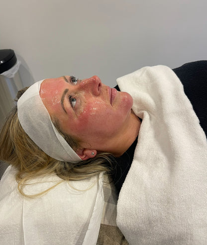 Advanced Microneedling