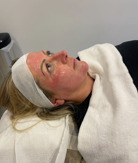 Advanced Microneedling