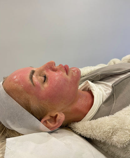 Advanced Microneedling