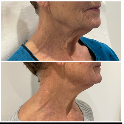 Radio Frequency Skin- Tightening Face and Neck Treatment