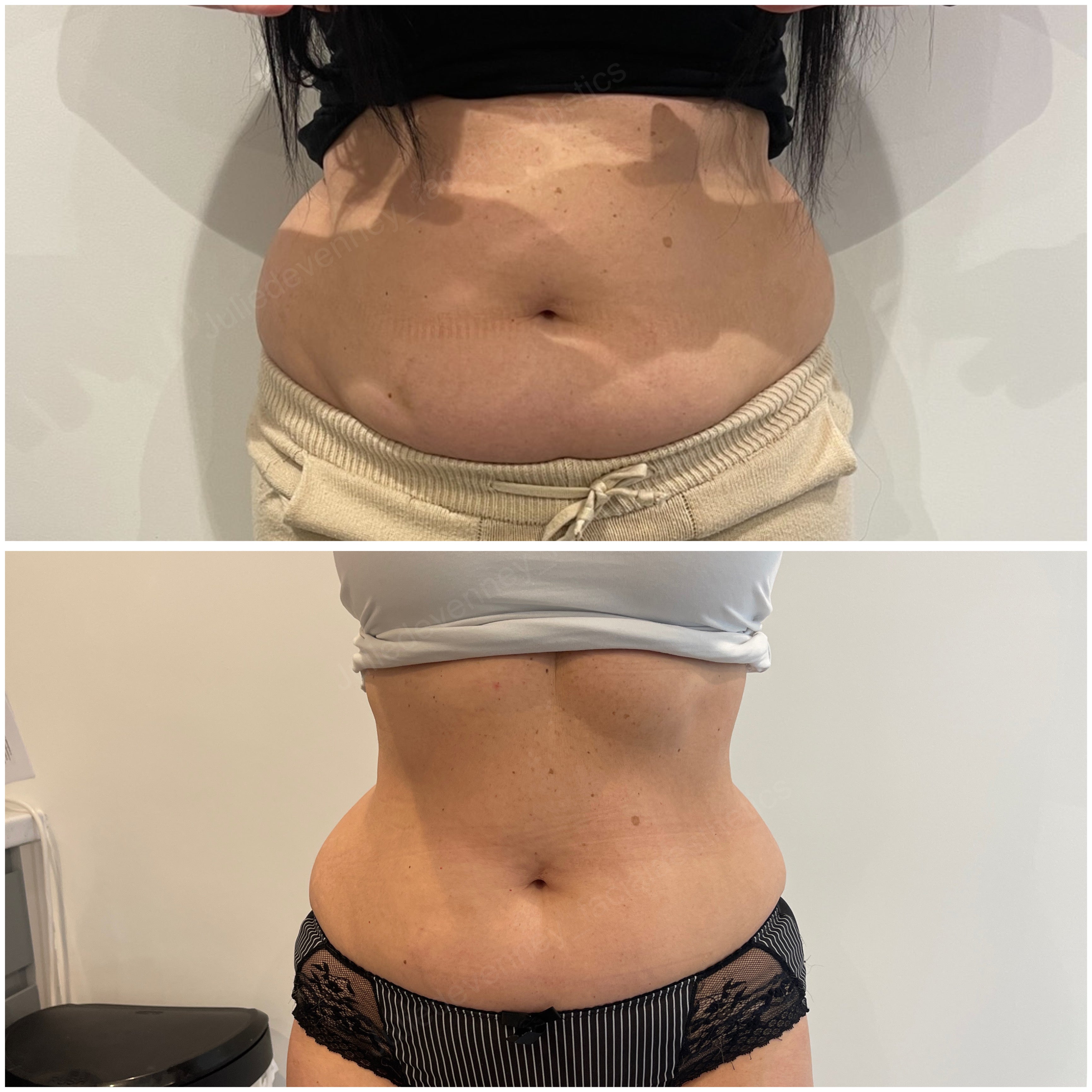 Before and after comparison of a person's waist area shrinking