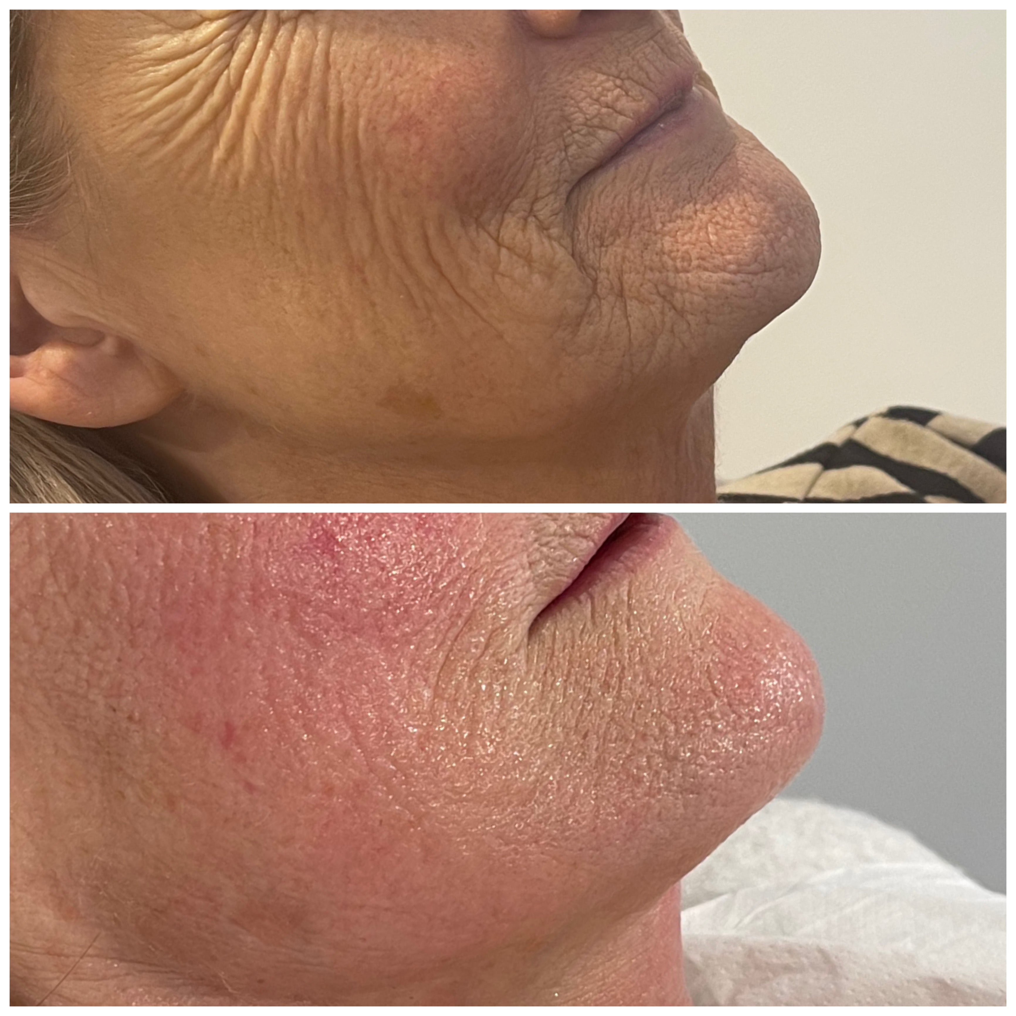 Before and after comparison of a person's neck skin texture.