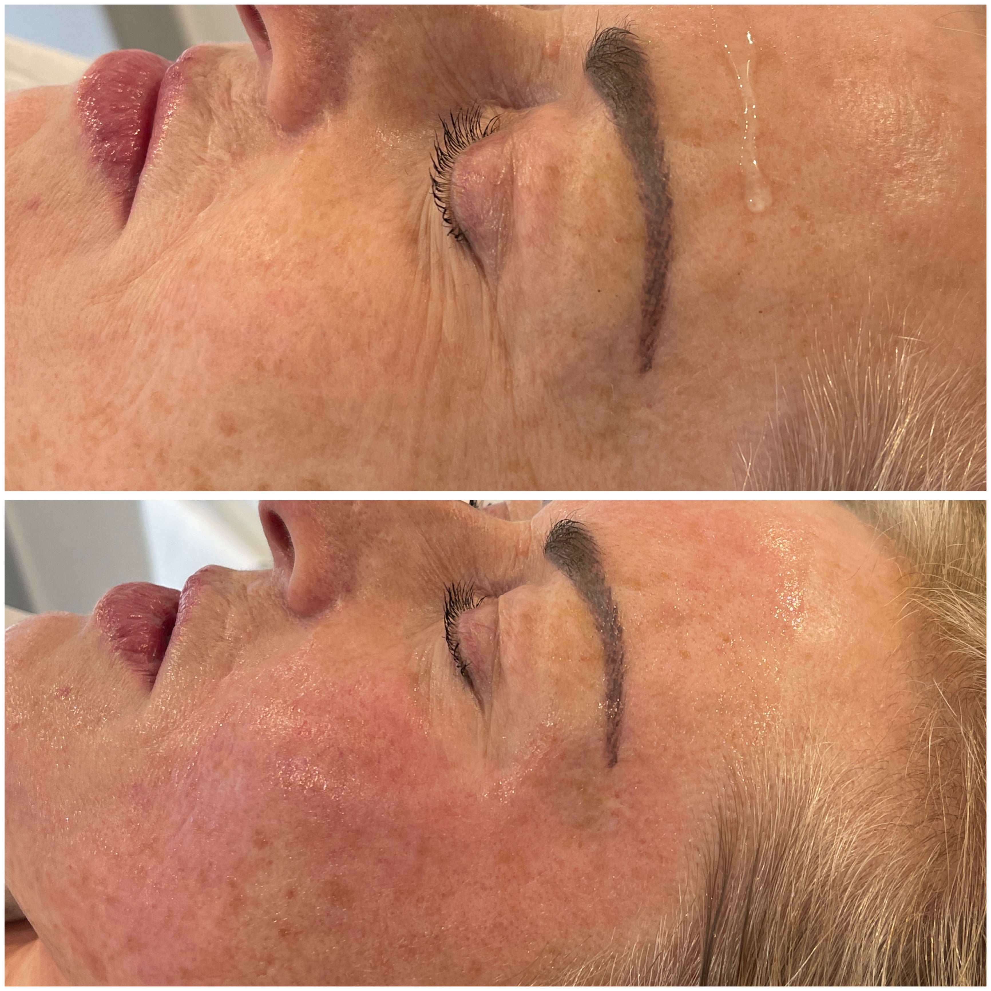 Before and after comparison of a person's eye area with and with a  radio frequency treatment.