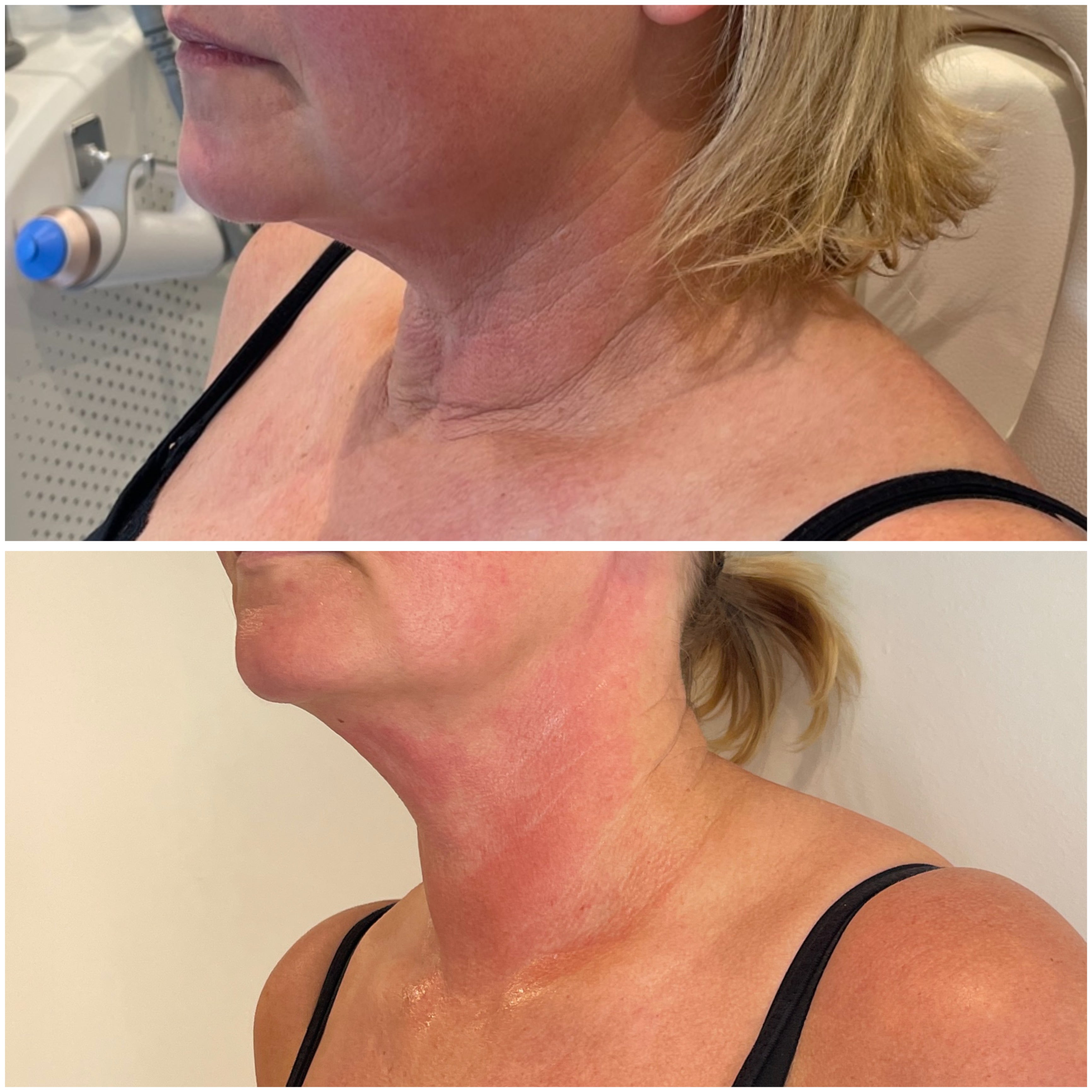 Before and after comparison of a woman's neck area with visible skin texture differences.