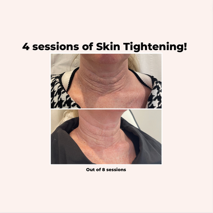 Radio Frequency Face and Neck - Package
