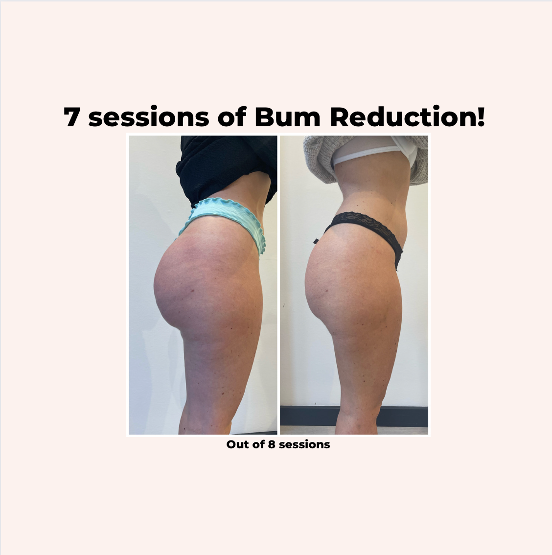 Bum Lift