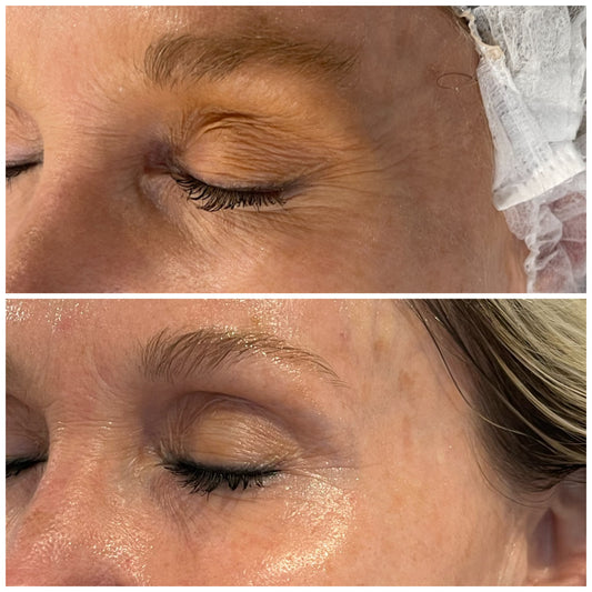 Non-Surgical Brow Lift