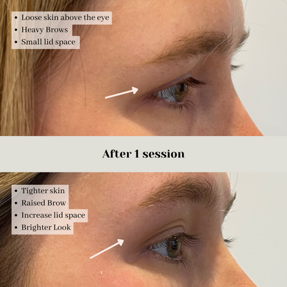 Non-Surgical Brow Lift