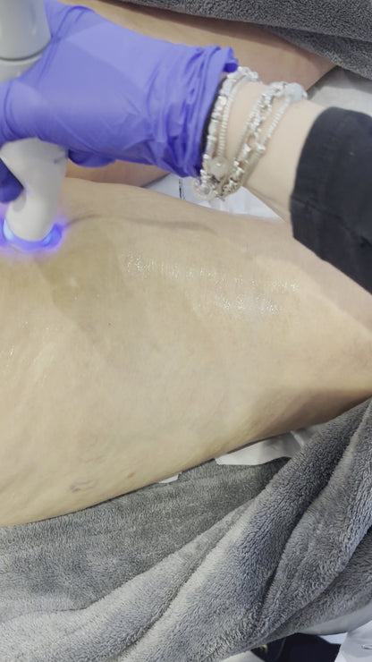 Non-Surgical Cellulite Reduction