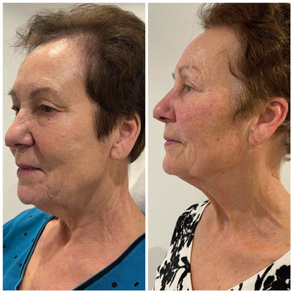 Radio Frequency Skin- Tightening Face and Neck Treatment