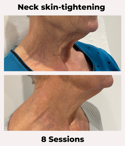 Radio Frequency Skin- Tightening Face and Neck Treatment