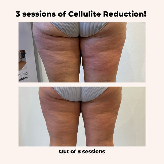 Non-Surgical Cellulite Reduction