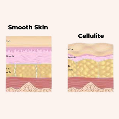 Non-Surgical Cellulite Reduction