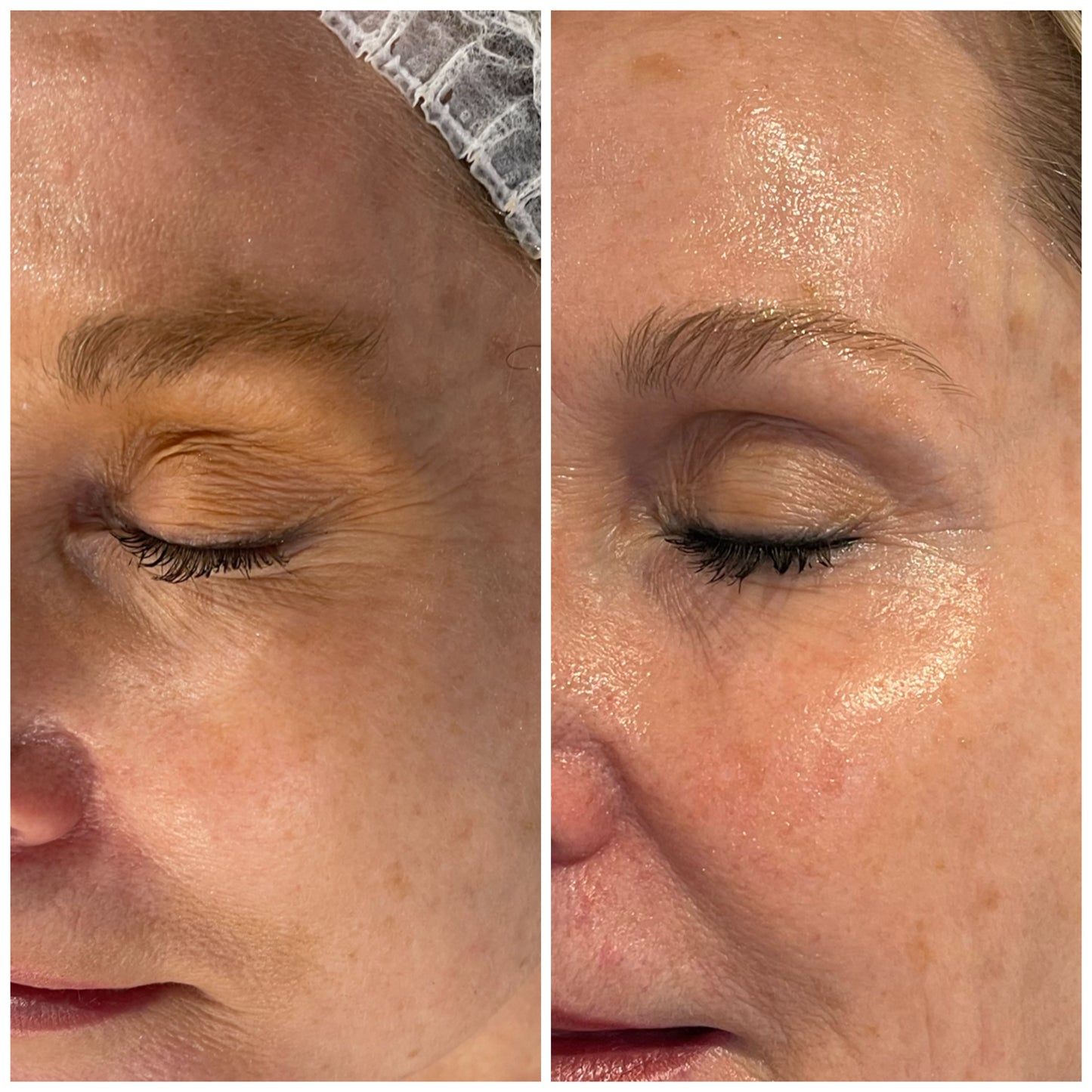 Non-Surgical Brow Lift