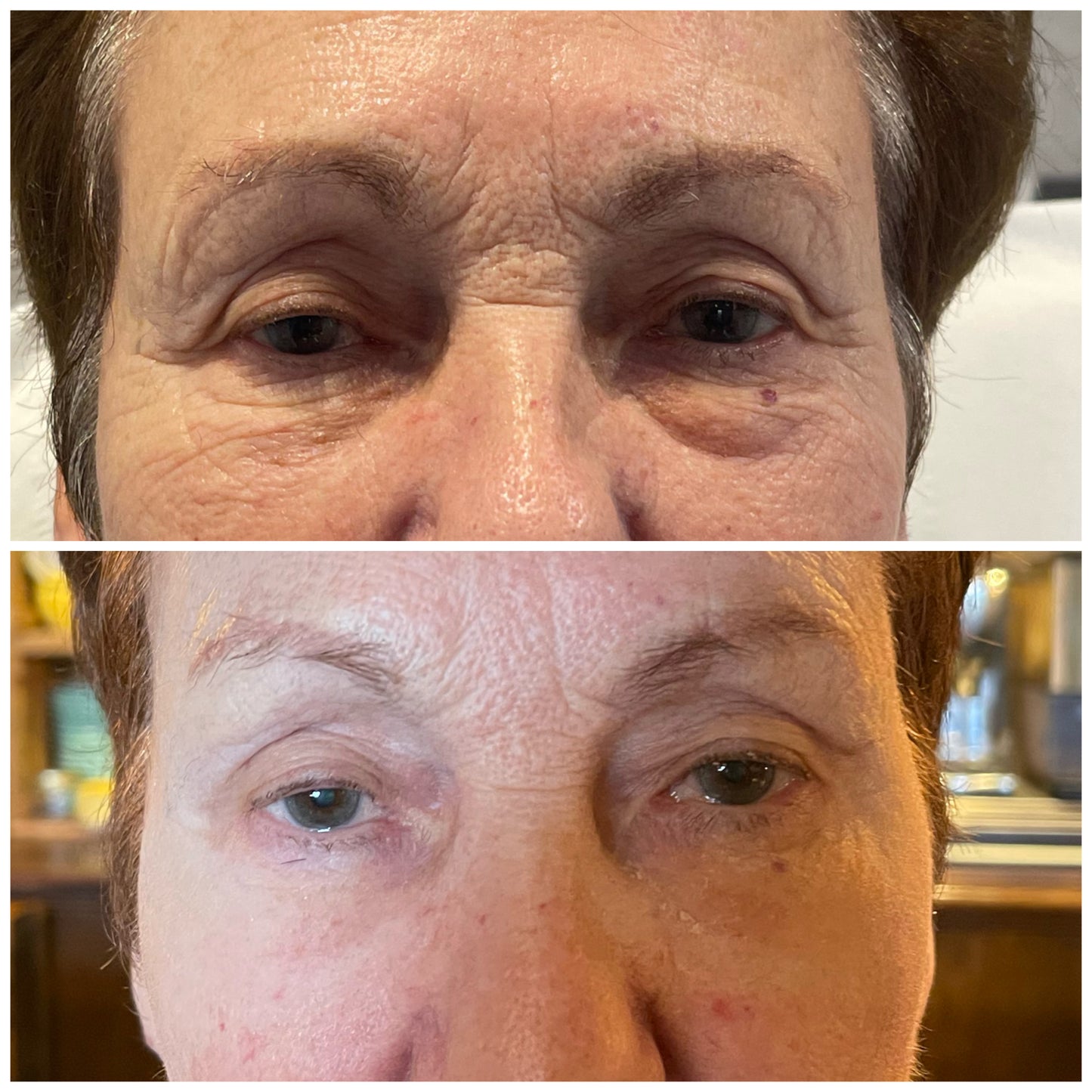 Non-Surgical Brow Lift