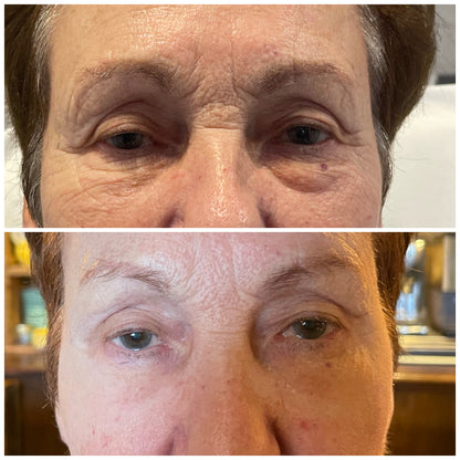 Non-Surgical Brow Lift