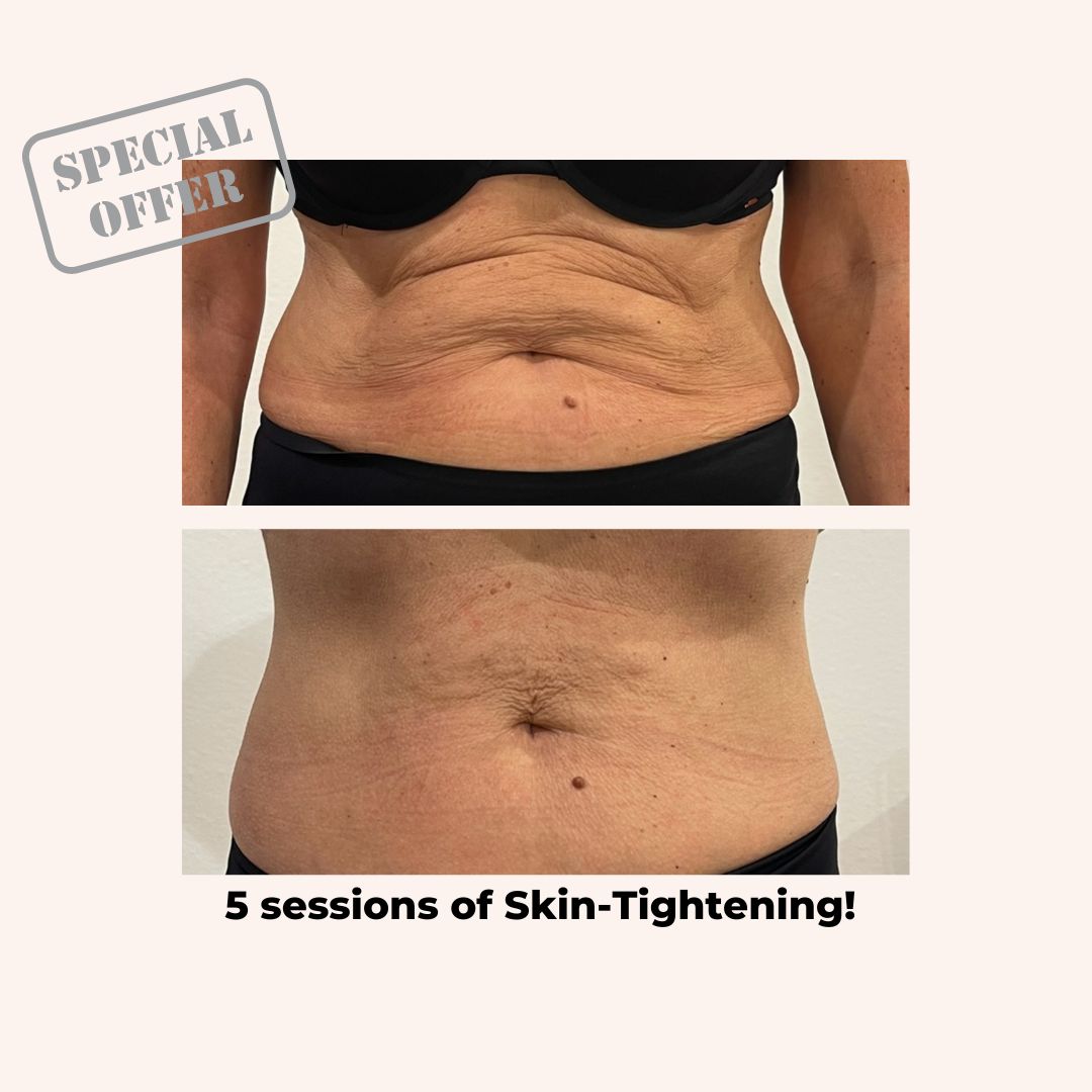 Body Skin-Tightening Package