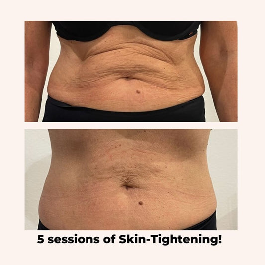 Body Skin-Tightening