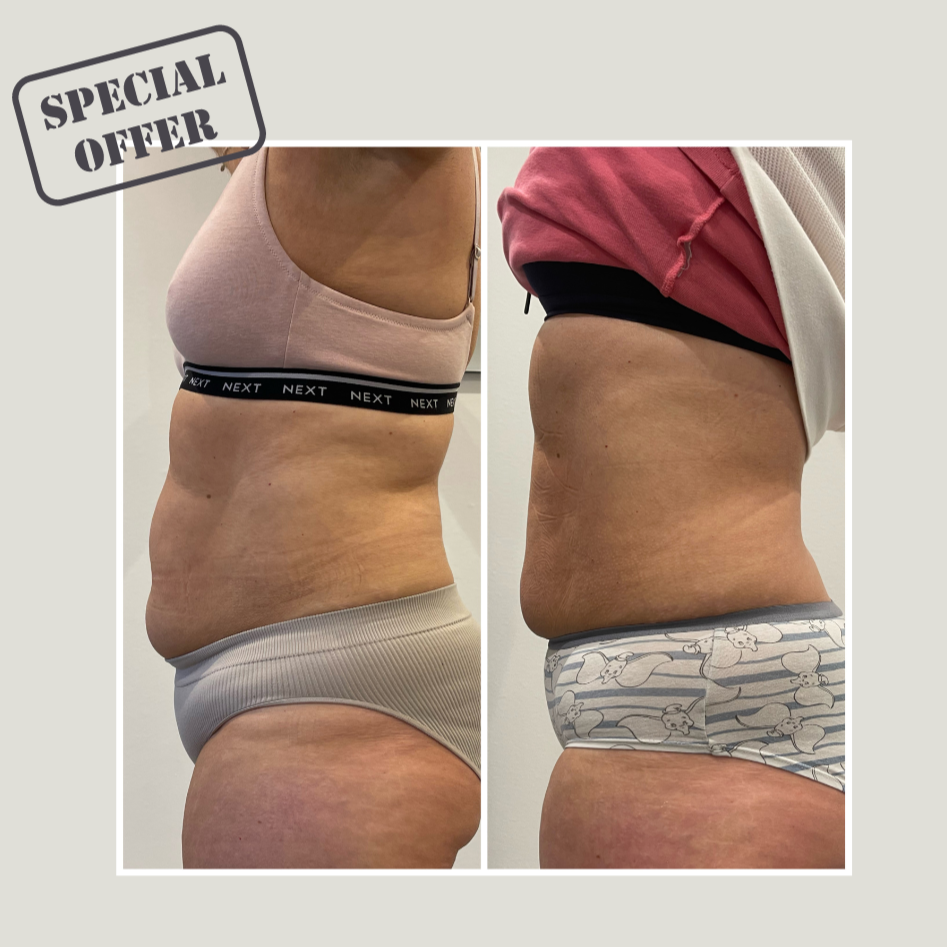 Ultimate Tummy Inch Loss - Female Package